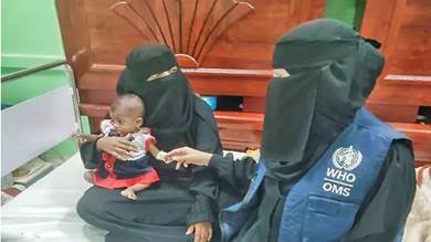 منظمة الصحة العالمية: مليونا طفل دون سن الخامسة في اليمن يعانون من الهزال